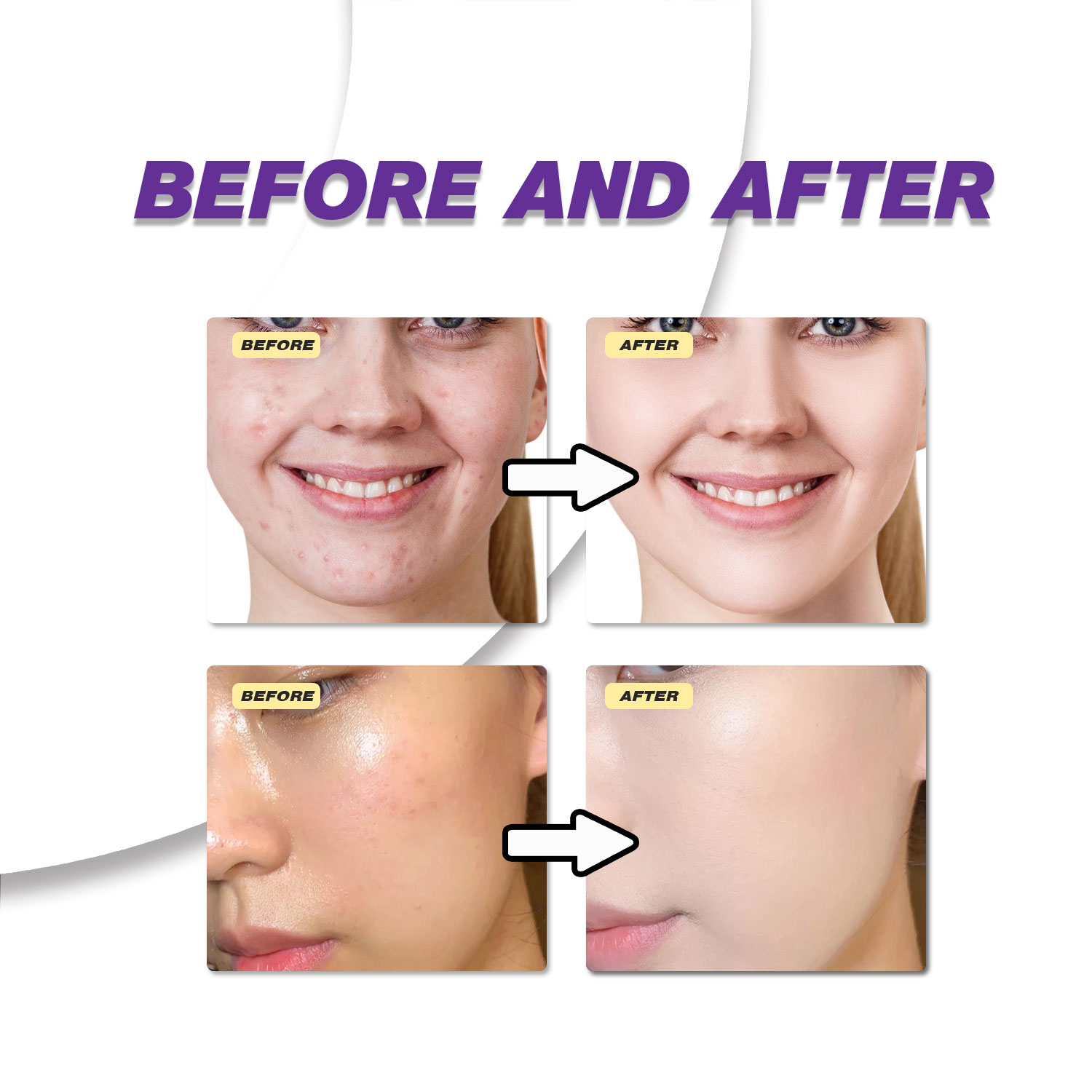 Mild Azelaic Acid Cream Improv - Azelaic Acid Cream review and price